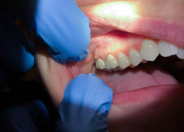 Best Emergency Denture Repair in Lake Waccamaw, NC