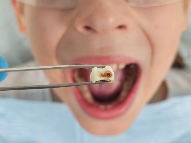 Best Dental Abscess Treatment in Lake Waccamaw, NC